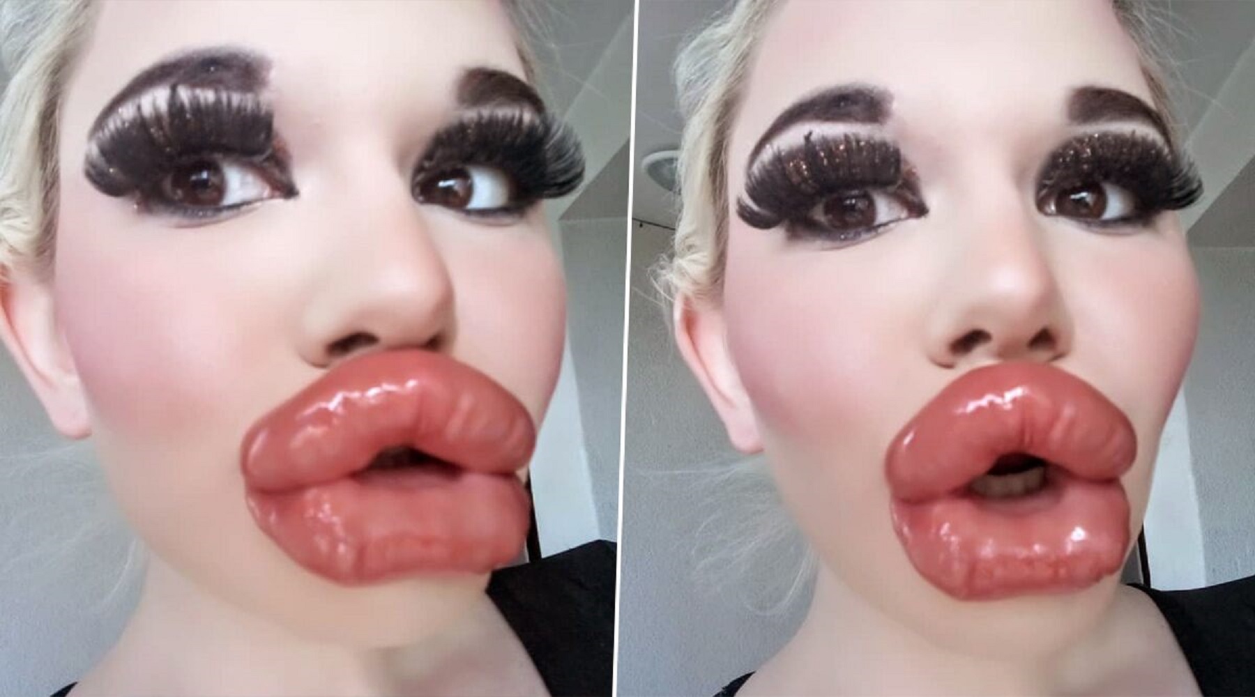 Lips Botox Gone Wrong Lipstutorial Org